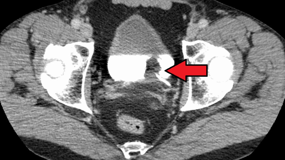 Bladder cancer