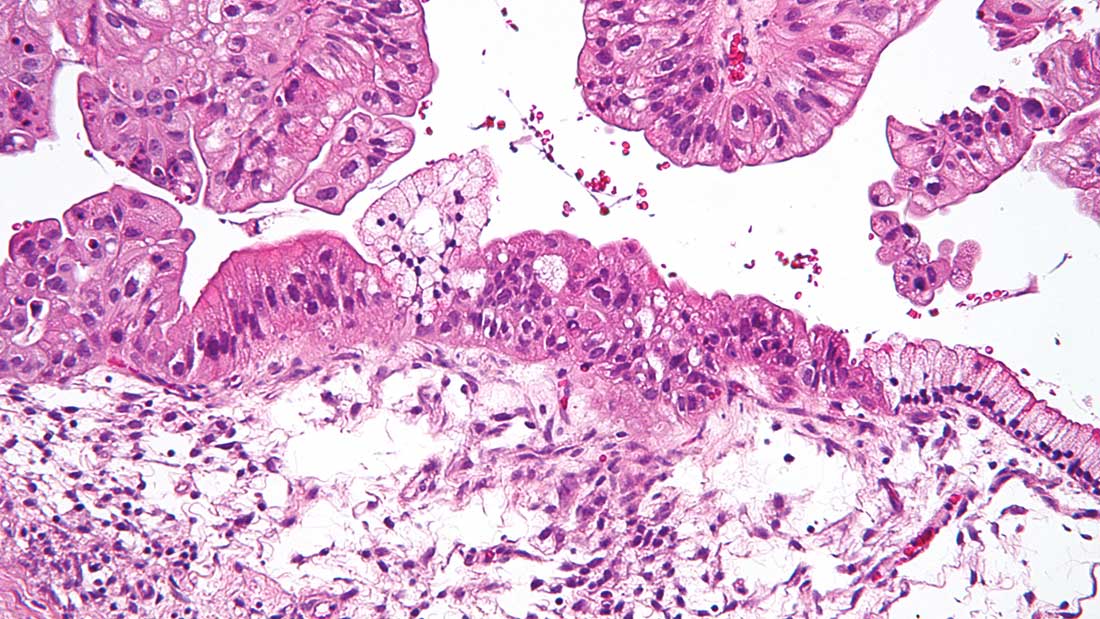 Mucinous ovarian tumour