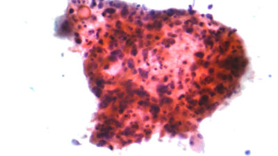 Squamous carcinoma lung